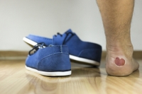 When to See a Chiropodist for Blisters