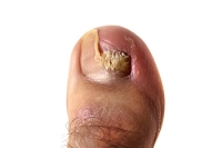Diagnosis of Fungal Toenails
