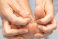Managing an Athlete’s Foot Infection