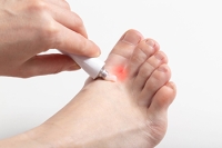 Causes of Athlete’s Foot Infection