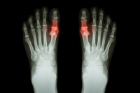 Phases and Risk Factors of Gout