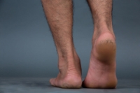 Cracked Heels and Summer Foot Care