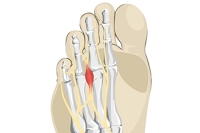 Symptoms and Diagnosis of Morton’s Neuroma
