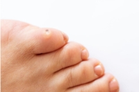 Causes of Foot Corns