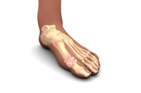 Complications From Gout