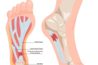 Treatment Options for Plantar Fasciitis